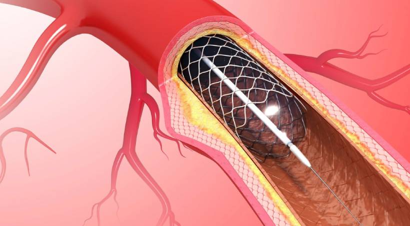 Angioplasty in Pune
