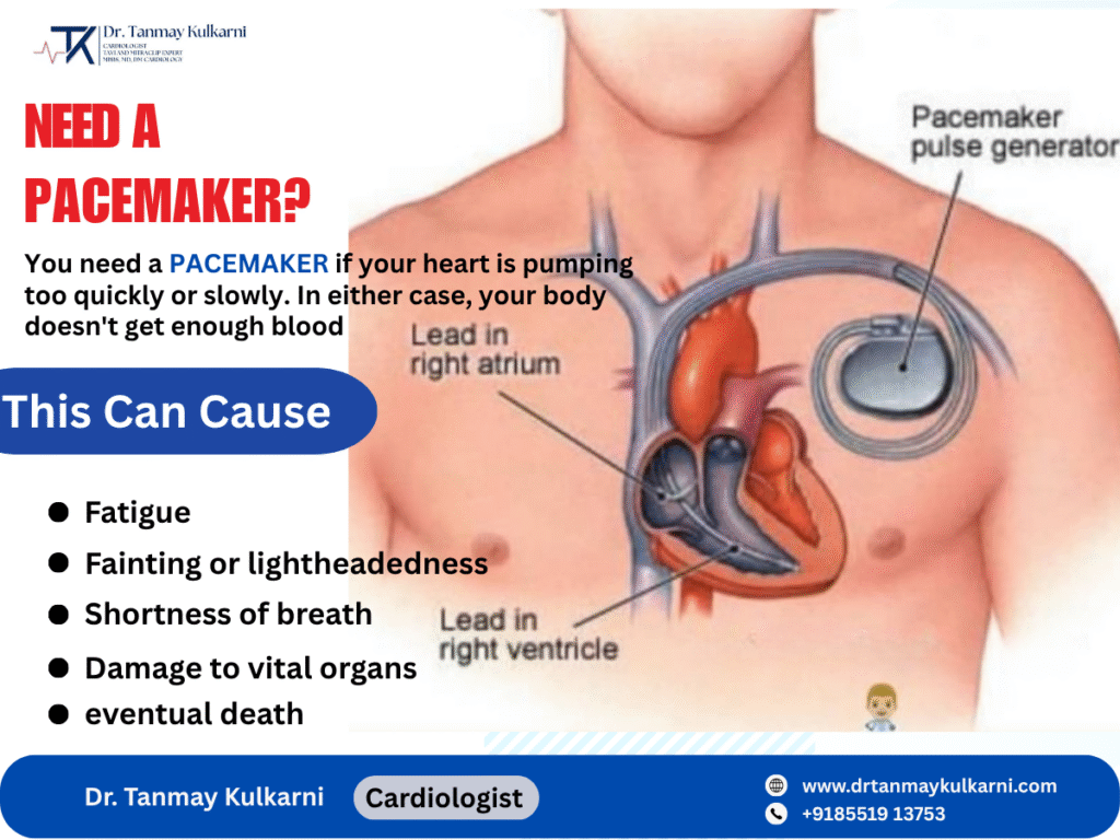 Pacemaker placement in chest showing leads connected to the right atrium and right ventricle to regulate heart rhythm.