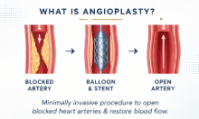 What Is Angioplasty