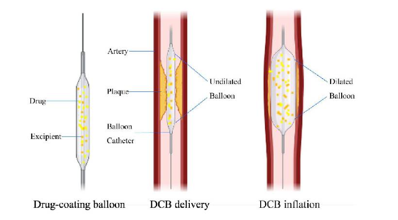 Angioplasty-15