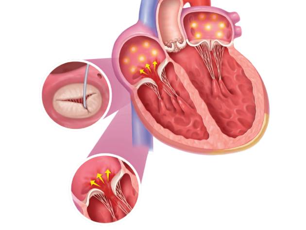 MitraClip-Procedure-14