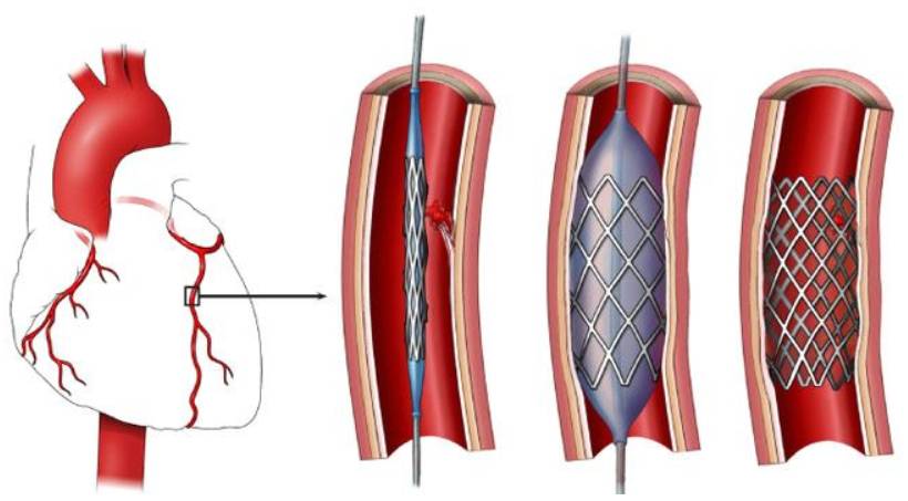 Stent Placement