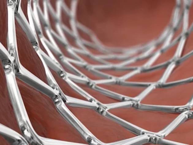 Stent-Placement-13