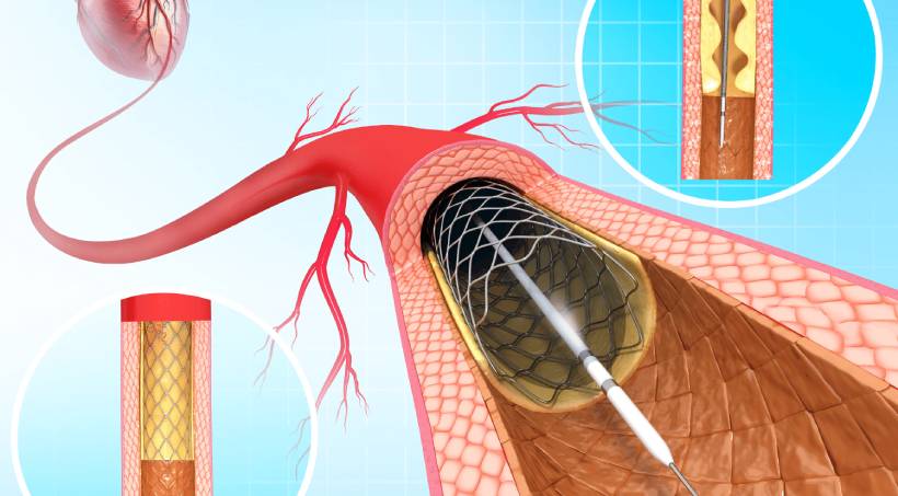 Stent-Placement-14