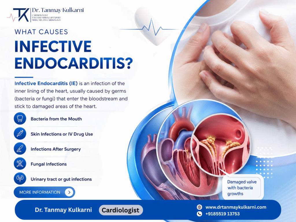 Infective Endocarditis: Causes, Symptoms, Risks & Treatment