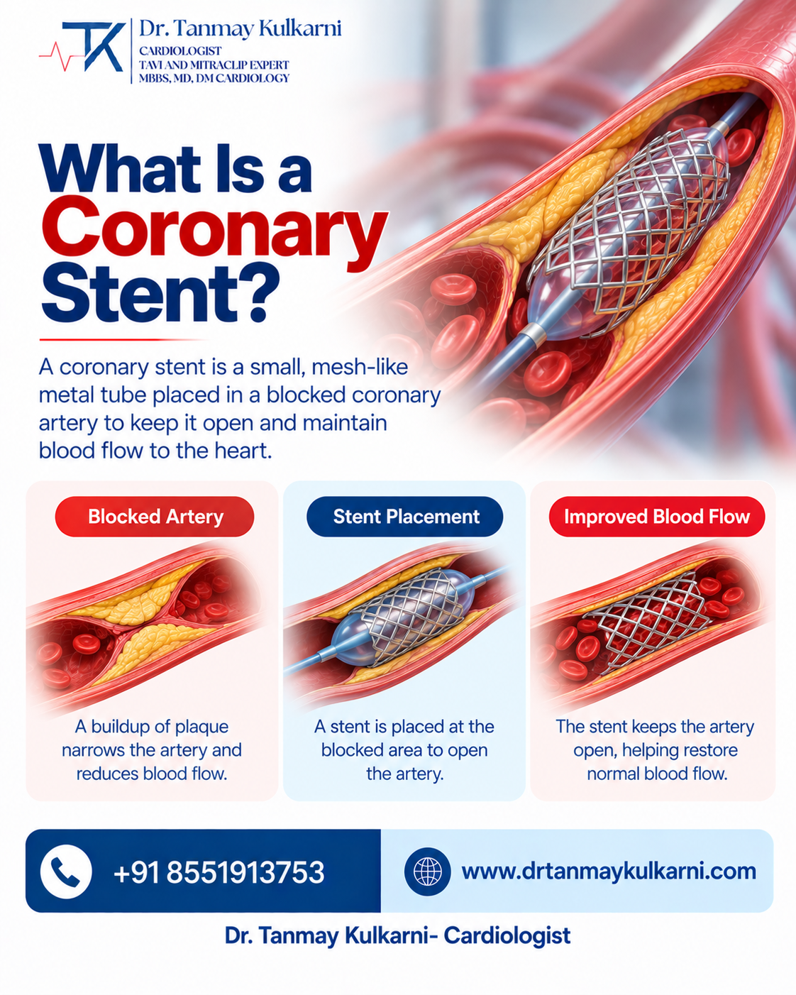 Coronary stent explained